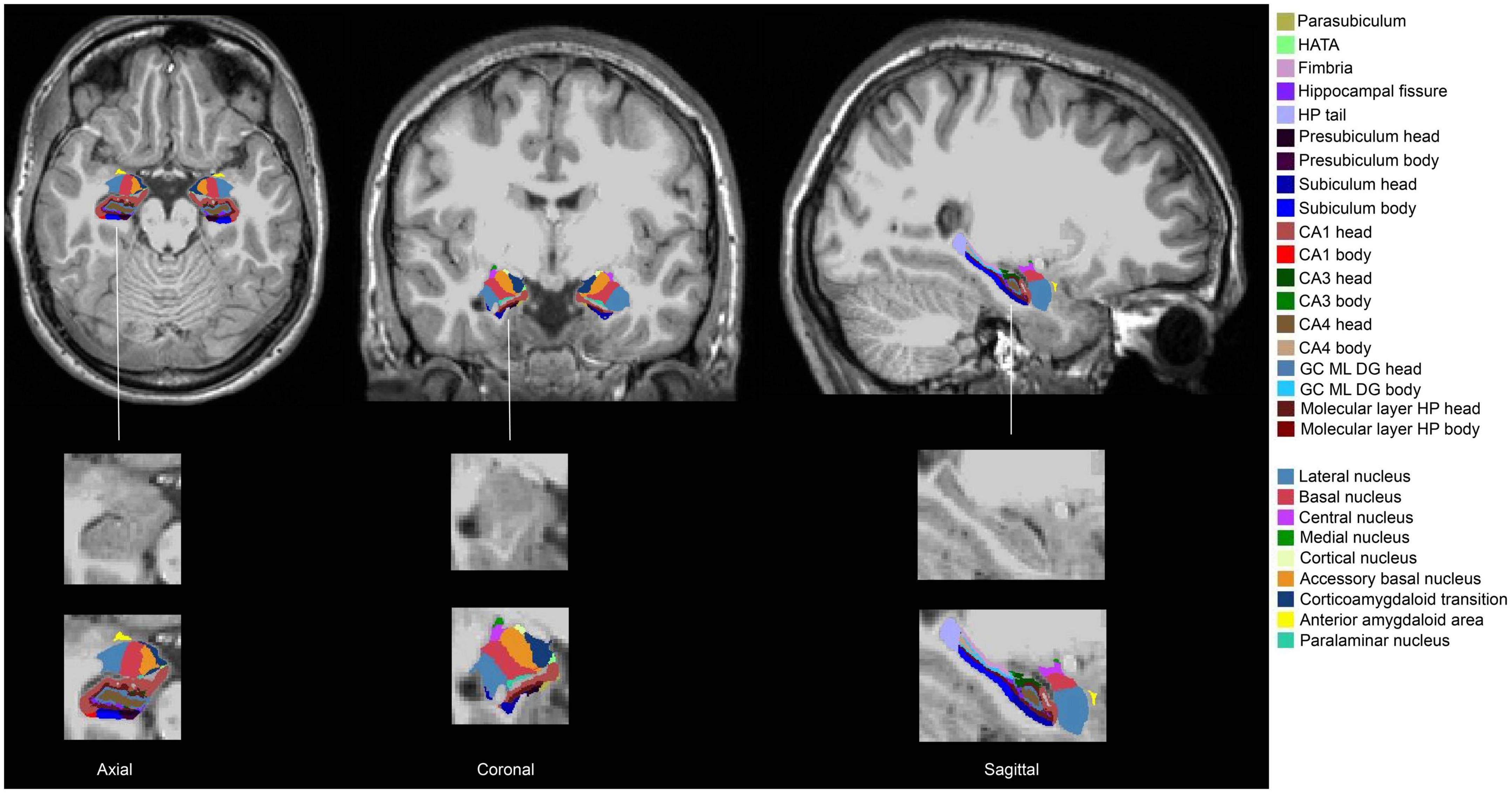 Neural correlates of disaster-related prenatal maternal stress in young adults from Project Ice Storm: Focus on amygdala, hippocampus, and prefrontal cortex